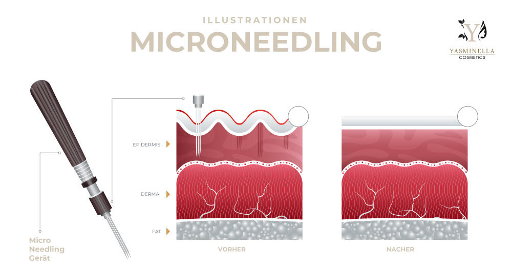 MICRONEEDLING-Illustrationen3 MICRONEEDLING-Illustrationen3