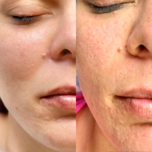 Microneedling
